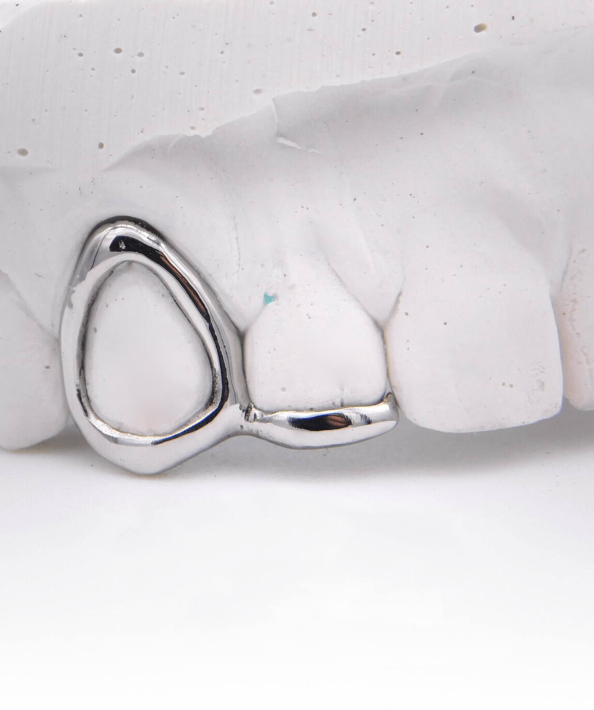 ICED London dental model featuring a silver dental crown/bridge on two adjacent teeth.