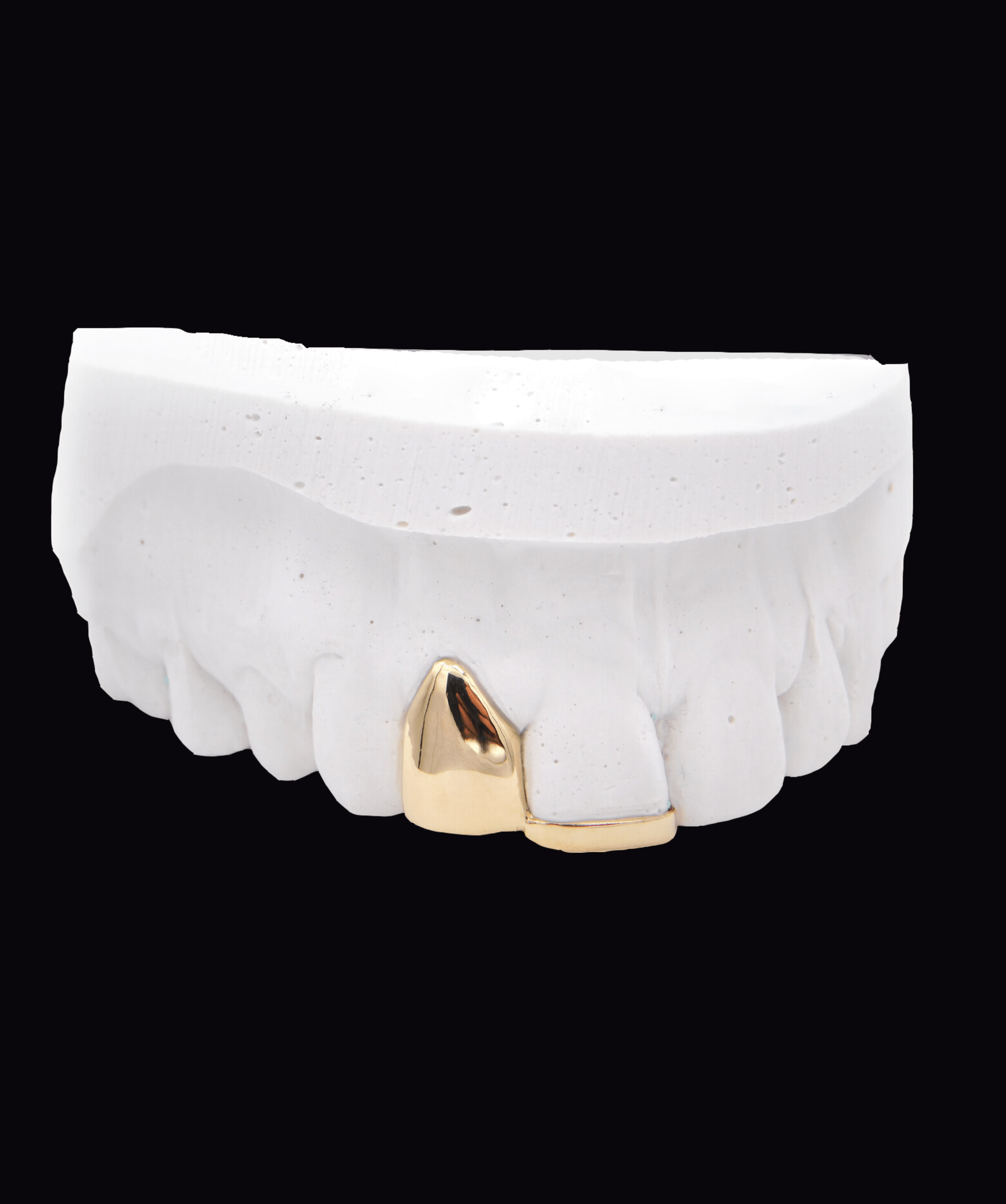 Dental model displaying a gold front crown on white teeth; ICED London.