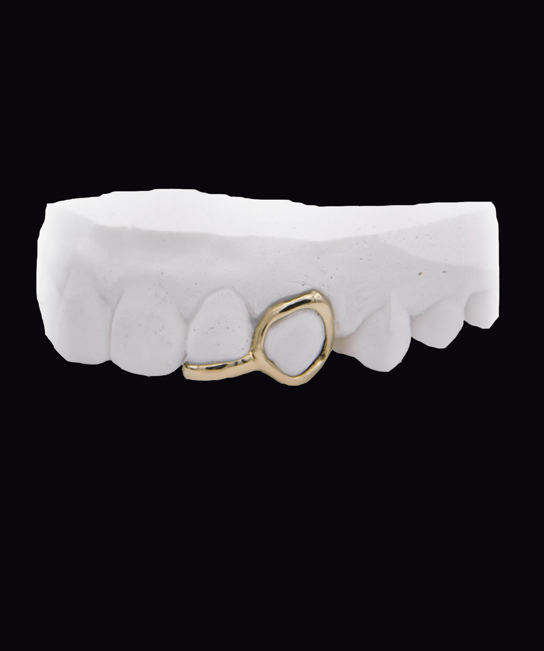 Dental model showing a gold loop clasp attached to a lower front tooth, ICED London.