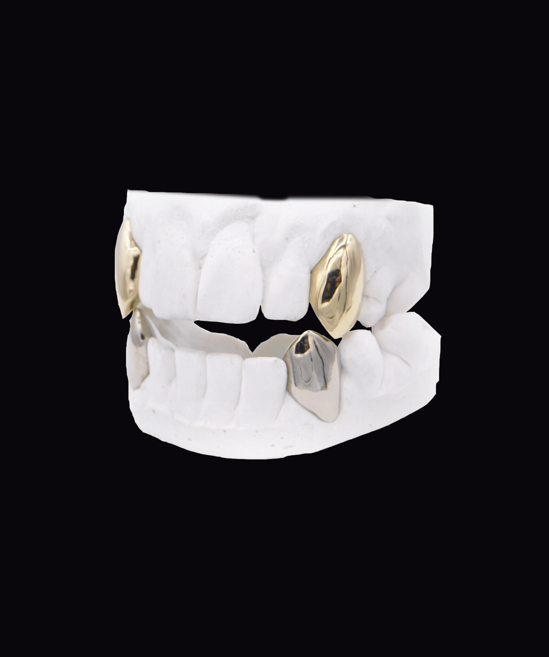 Dental plaster model with gold crowns on molars, showcasing dental restorations (ICED London).